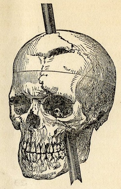 The case of Phineas Gage, 1823-1860, who survived for 12 years after a 1¼-inch diameter iron rod pierced his brain, made an early, gruesome contribution to our understanding of brain function. The accident changed his character completely. - DR. JOHN HARLOW, 1868