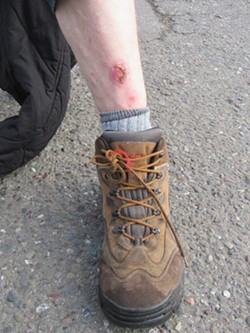 A healing scar on a MAC resident's leg. - LINDA STANSBERRY