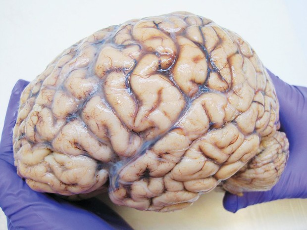 Autopsied human brain. Does all that folding and furrowing make us smarter?