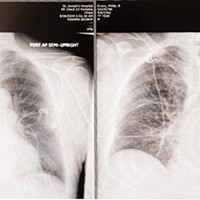 Right: X-ray taken in the ER soon after my accident shows all five lobes of my lungs (white spidery lines) filling up my entire chest cavity. Left: By the next morning my right superior lobe (top left) had collapsed. "What's that white blob in the middle?" I asked. "Your heart."